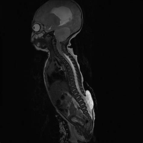 Chiari II malformation | Radiology Case | Radiopaedia.org | Chiari, Radiology, Myelomeningocele