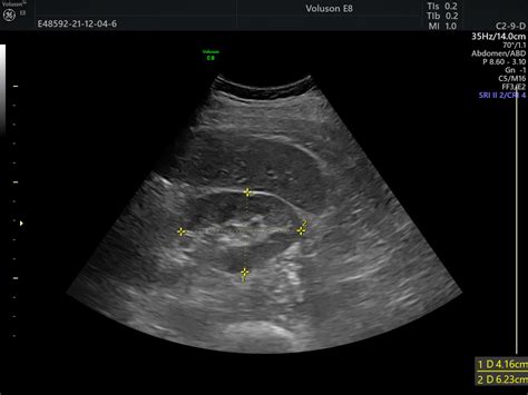 Anechoic Ultrasound