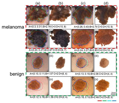 What Does Stage 1 Skin Cancer Look Like - CancerWalls