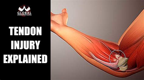 Tendinopathy 101: The Science behind Elbow Pain in Arm Wrestling - YouTube