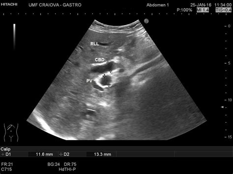 Dilatation of the common bile duct [2 images] – EFSUMB