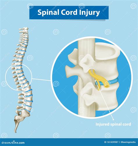 Diagram Showing Spinal Cord Injury Stock Vector - Illustration of cord, living: 161439987