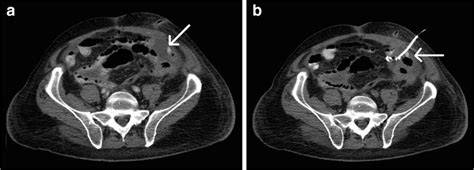 Computed tomography (CT) scan obtained on postoperative day 8 after... | Download Scientific Diagram