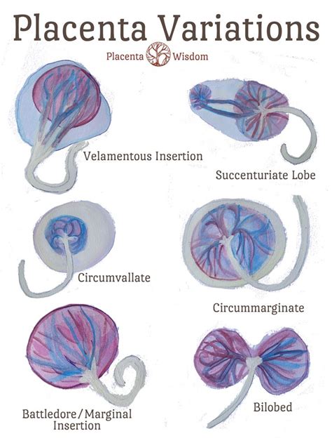 Placenta Variations | Midwifery student, Student midwife, Birth education