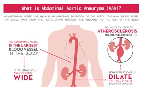 Aneurysm Symptoms - Abdominal Aortic Aneurysm Treatment Abdominal Aortic Aneurysm Symptoms ...