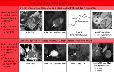 O-RADS MRI Calculator - RadioGyan