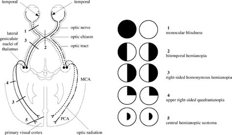 homonomous hemianopia - بحث Google‏ | Medical school stuff, School info, Visual cortex