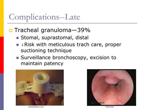 PPT - Pediatric Tracheostomy PowerPoint Presentation, free download ...