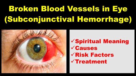 Spiritual Meaning of Broken Blood Vessel in Eye & Treatment