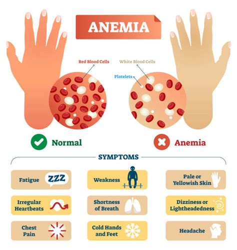 Anemia Illustrations, Royalty-Free Vector Graphics & Clip Art - iStock