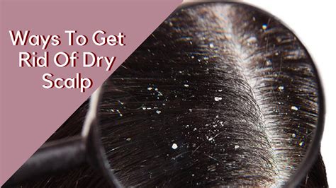 Way To Get Rid Of Dry Scalp in 2020 | Dry scalp, Scalp moisturizer, Dry flaky scalp