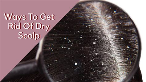 Way To Get Rid Of Dry Scalp in 2020 | Dry scalp, Scalp moisturizer, Dry ...