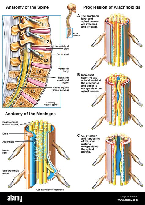 Arachnoiditis hi-res stock photography and images - Alamy