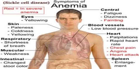 Sickle cell disease (Symptoms, Diagnosis, and Treatment) - Assignment Point