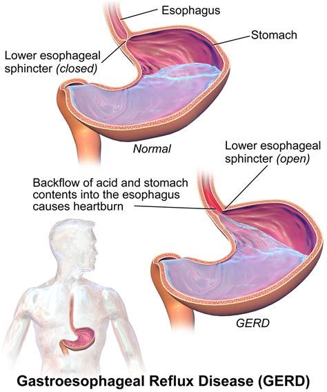 Dysphagia pathophysiology - wikidoc