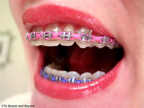 Pin by J T on Braces | Braces girls, Cute braces colors, Braces colors