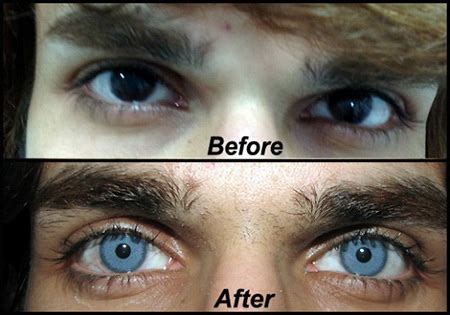 Doctor Uses Special Surgical Procedure to Permanently Change Eye Color - TechEBlog