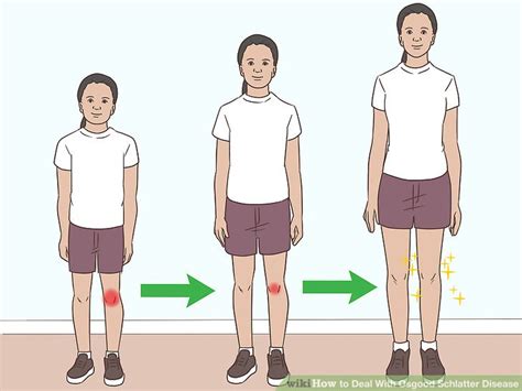 3 Ways to Deal With Osgood Schlatter Disease - wikiHow