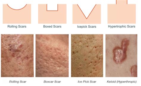 Acne Scars - PREMIER DERM MD | TREATING ACNE & SCARRING, WRINKLES, DARK ...