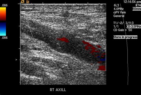 Deep vein thrombosis ultrasound - wikidoc