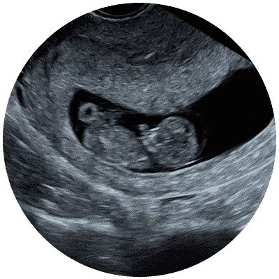 Early Scans from Just 6 Weeks - Window to the Womb & firstScan