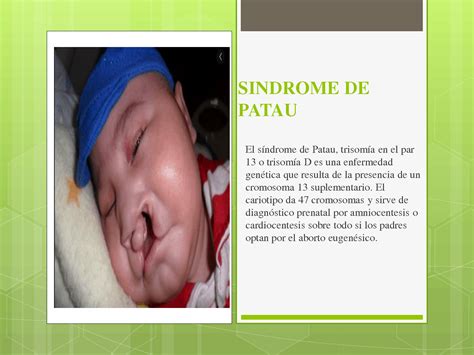 SOLUTION: Sindrome de patau - Studypool