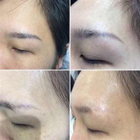 Eyeliner Tattoo Removal Process and Success