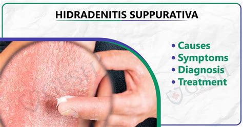 Hidradenitis Suppurativa: Causes, Symptoms, Diagnosis, and Treatment