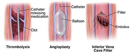 Procedures for Deep Vein Thrombosis | Saint Luke's Health System