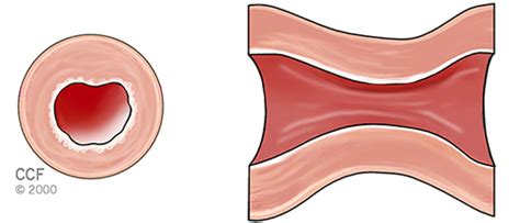 Heart Attack (Myocardial Infarction) Types of Heart Attacks | Cleveland ...