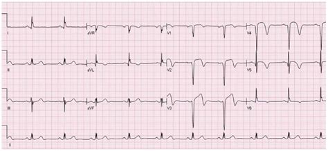 ST-segment elevation: Distinguishing ST elevation myocardial infarction from ST elevation ...