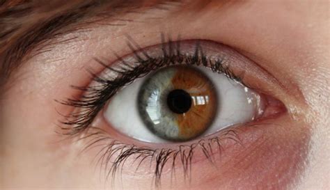 Central Heterochromia – Reasons, Possibility and its Types - upsmash