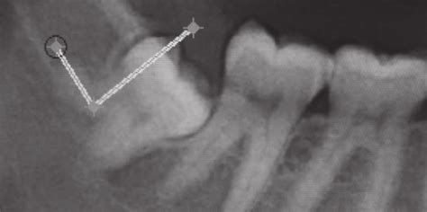 A tooth was recognized as having mesial or distal root dilacerations if... | Download Scientific ...