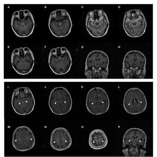 FIGURE E MRI of patient t showed significant bilateral temporal lobe ...