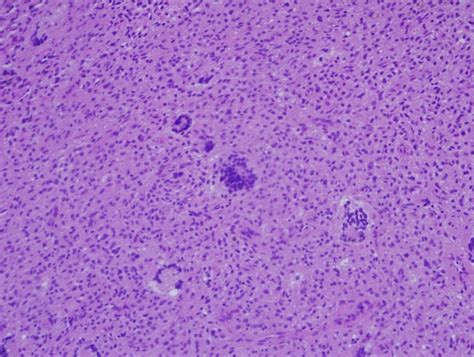 Juvenile xanthogranuloma. Foamy histiocytes aggregates with classic... | Download Scientific Diagram