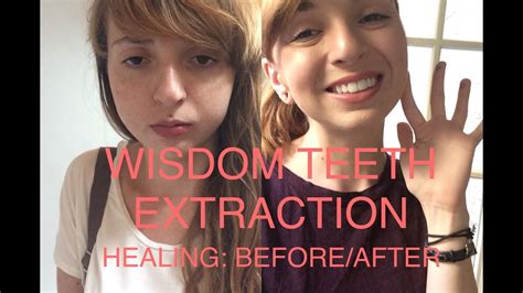 Wisdom teeth extraction! Before and after/healing process! - YouTube