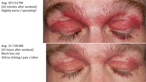 Intermittent and worsening eyelid (heliotrope) rash : DiagnoseMe