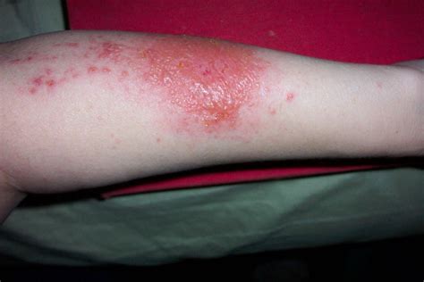 Kontaktdermatitis: Auslöser und Behandlung - DEMedBook