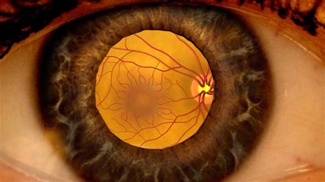 Animation: Detecting diabetic retinopathy through a dilated eye exam - YouTube