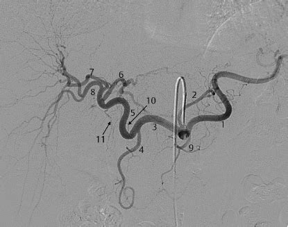 Celiac Artery Angiogram