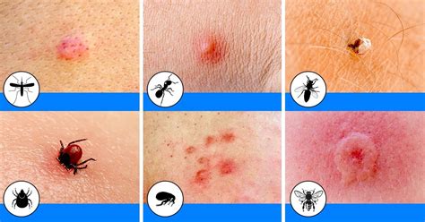 10 Bug Bites Anyone Should Be Able to Identify / Bright Side