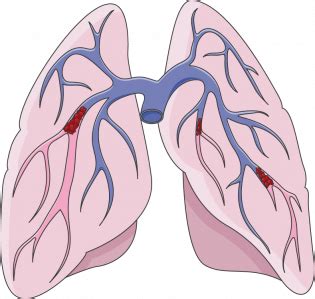 Pulmonary embolism (blood clot in the lungs) – Sleep and Lung Care