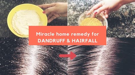 Miracle Cure For Dandruff & Hair Fall | MAGICAL HOME REMEDY to TREAT ...