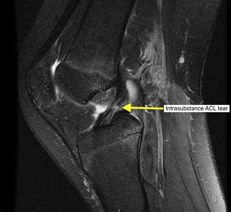 Mri Knee Acl Tear