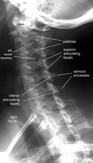 Radiographic Anatomy of the Skeleton: Cervical Spine -- Left Anterior Oblique View, Labelled