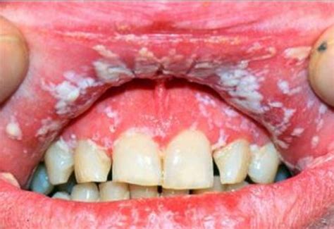 White Spots in Mouth and Small Painful White Patches in Mouth Causes, Treatment – Treat, Cure Fast