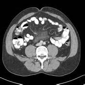 Misty mesentery | Radiology Reference Article | Radiopaedia.org