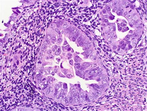 Precancerous Lesions of Endometrial Serous Carcinomas | Obgyn Key