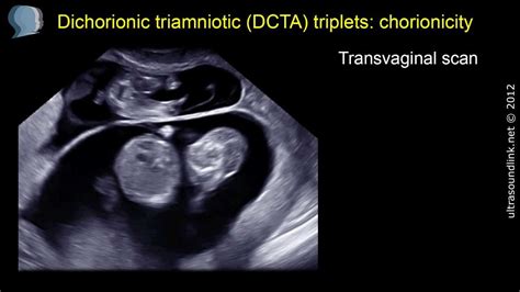 Chorionicity determination: lambda sign on 3D scan - YouTube