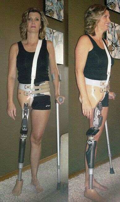 Pin by Luis Del Rosario on Bespoke Médicos | Prosthetic leg, Amputee lady, Prosthetics